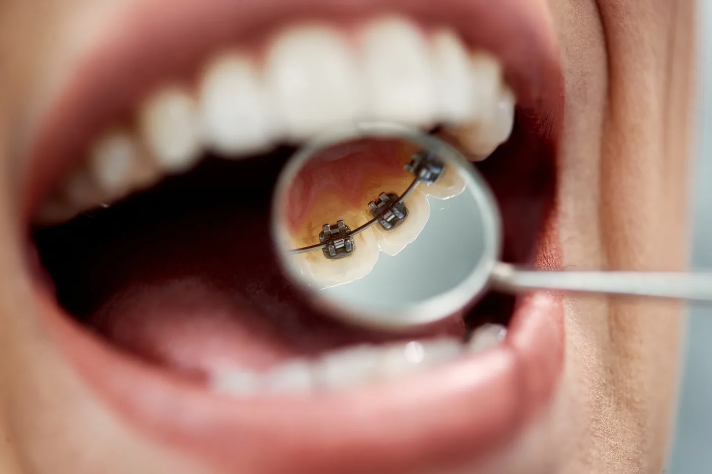 Close-up of lingual braces fitted to the inside of the teeth Close-up of lingual braces fitted to the inside of the teeth
