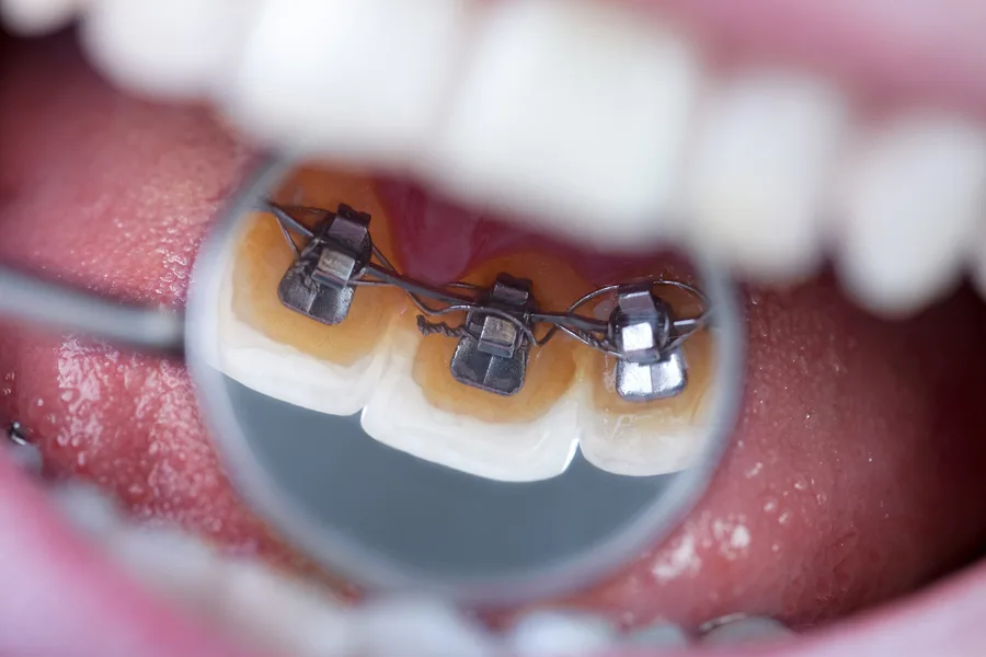 Close-up of lingual braces fitted to the inside of the teeth Close-up of lingual braces fitted to the inside of the teeth