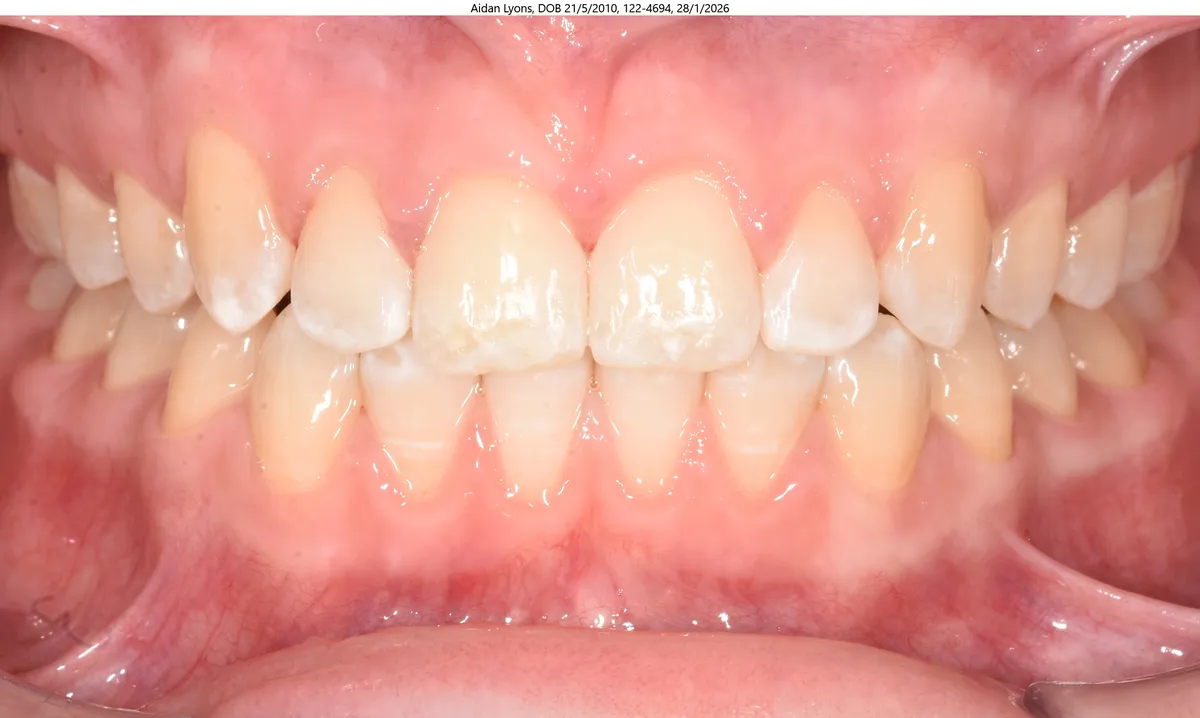 Aidan's smile after Invisalign® treatment Aidan's smile after Invisalign® treatment