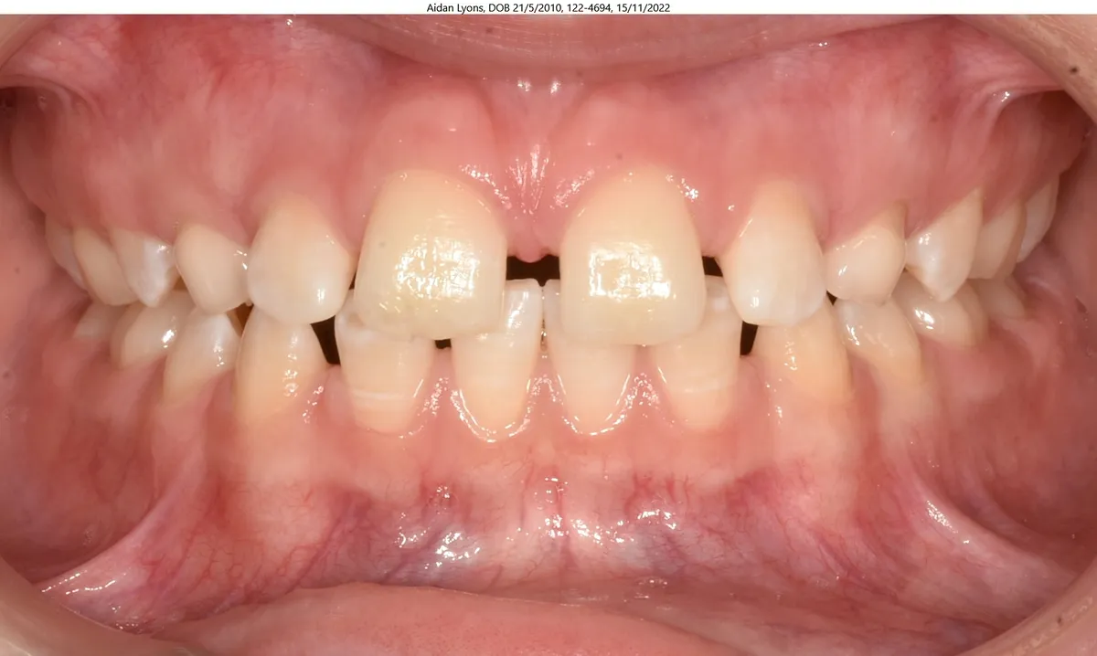 Aidan's smile before Invisalign® treatment Aidan's smile before Invisalign® treatment