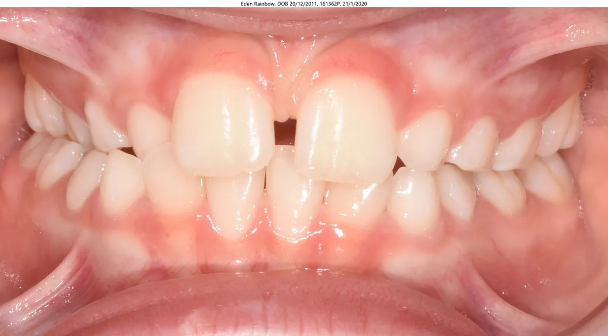 Eden's smile before Expander & braces treatment Eden's smile before Expander & braces treatment