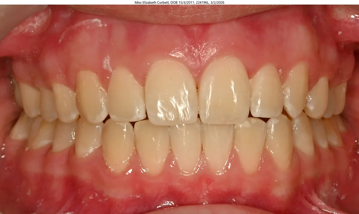 Elizabeth's smile after Invisalign® treatment Elizabeth's smile after Invisalign® treatment