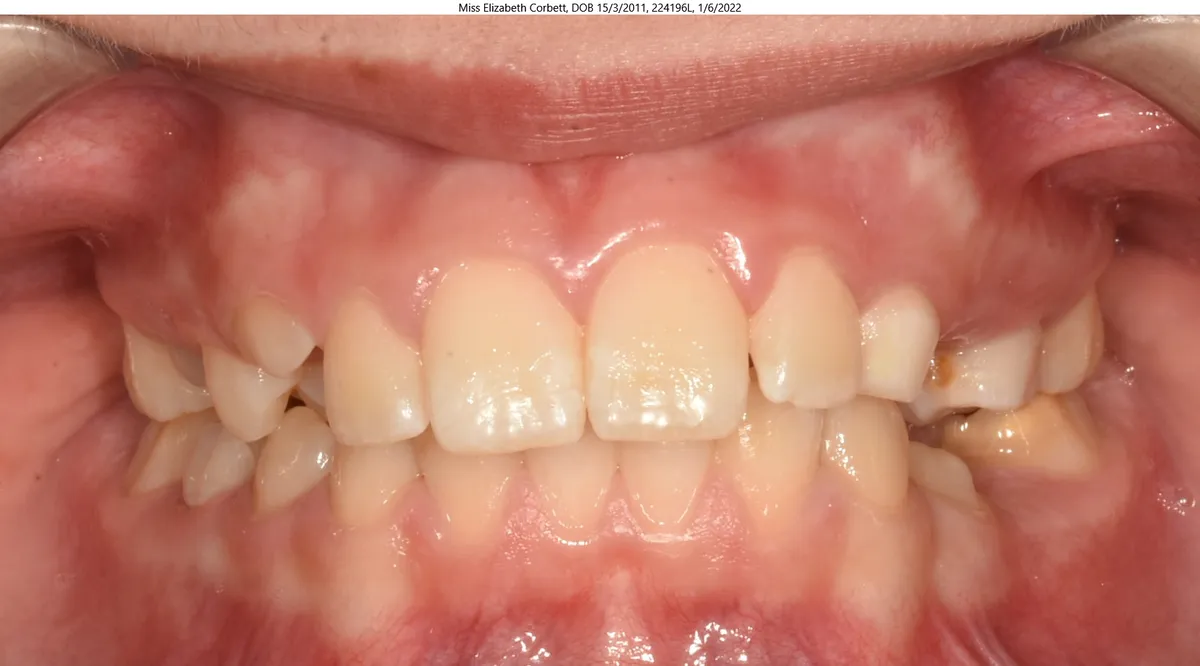 Elizabeth's smile before Invisalign® treatment Elizabeth's smile before Invisalign® treatment