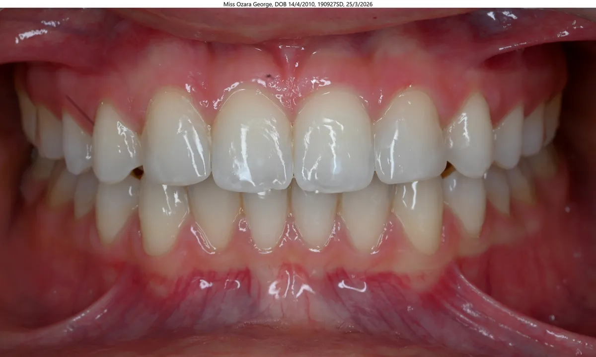 George's smile after TADs, mesial slider & braces treatment George's smile after TADs, mesial slider & braces treatment