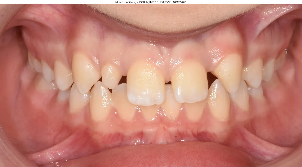 George's smile before TADs, mesial slider & braces treatment George's smile before TADs, mesial slider & braces treatment