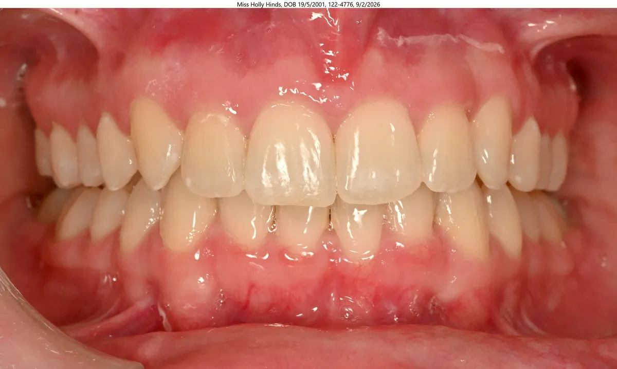 Holly's smile after Invisalign® treatment Holly's smile after Invisalign® treatment