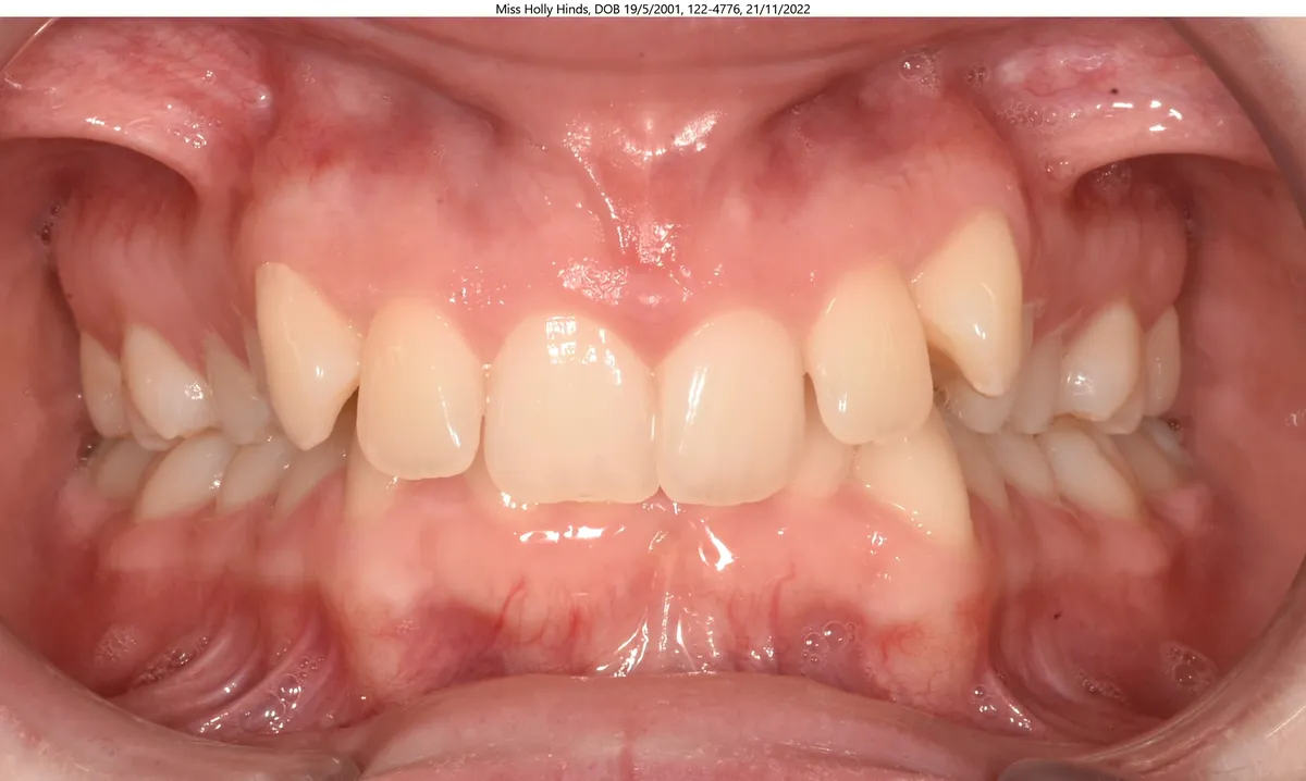 Holly's smile before Invisalign® treatment Holly's smile before Invisalign® treatment