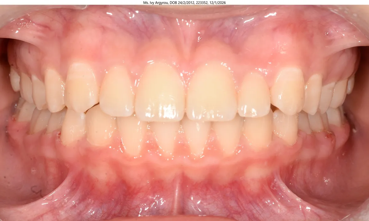 Ivy's smile after Expander & braces treatment Ivy's smile after Expander & braces treatment