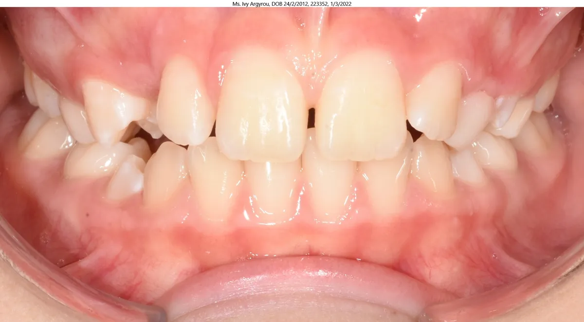 Ivy's smile before Expander & braces treatment Ivy's smile before Expander & braces treatment