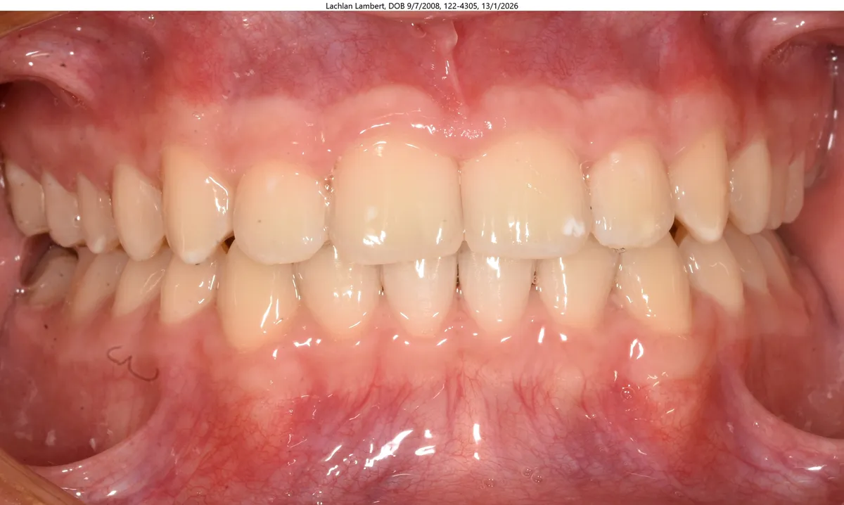 Lachlan's smile after Expander & Invisalign® treatment Lachlan's smile after Expander & Invisalign® treatment