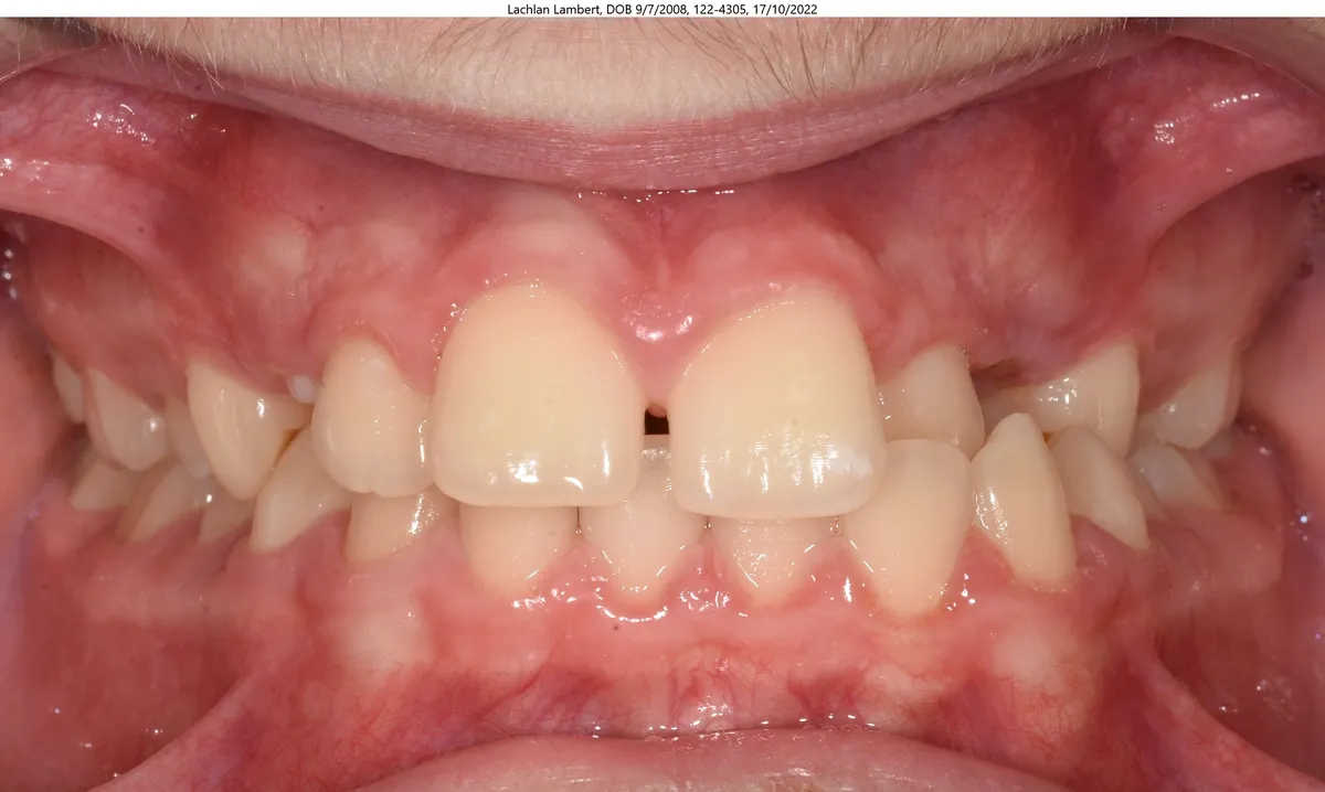 Lachlan's smile before Expander & Invisalign® treatment Lachlan's smile before Expander & Invisalign® treatment