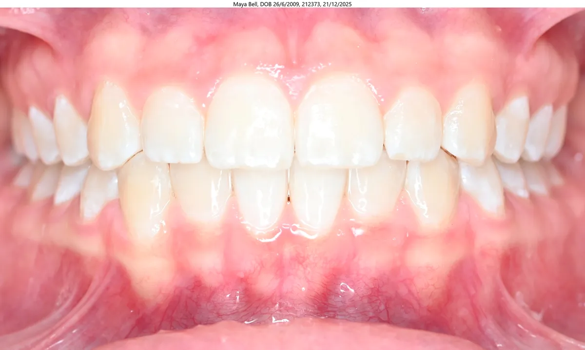 Maya's smile after Invisalign® treatment Maya's smile after Invisalign® treatment