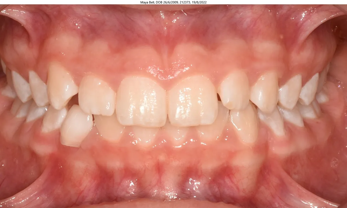Maya's smile before Invisalign® treatment Maya's smile before Invisalign® treatment
