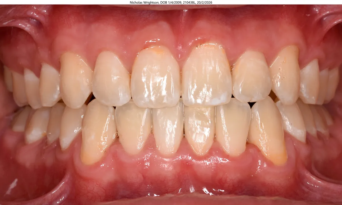 Nicholas's smile after Invisalign® treatment Nicholas's smile after Invisalign® treatment
