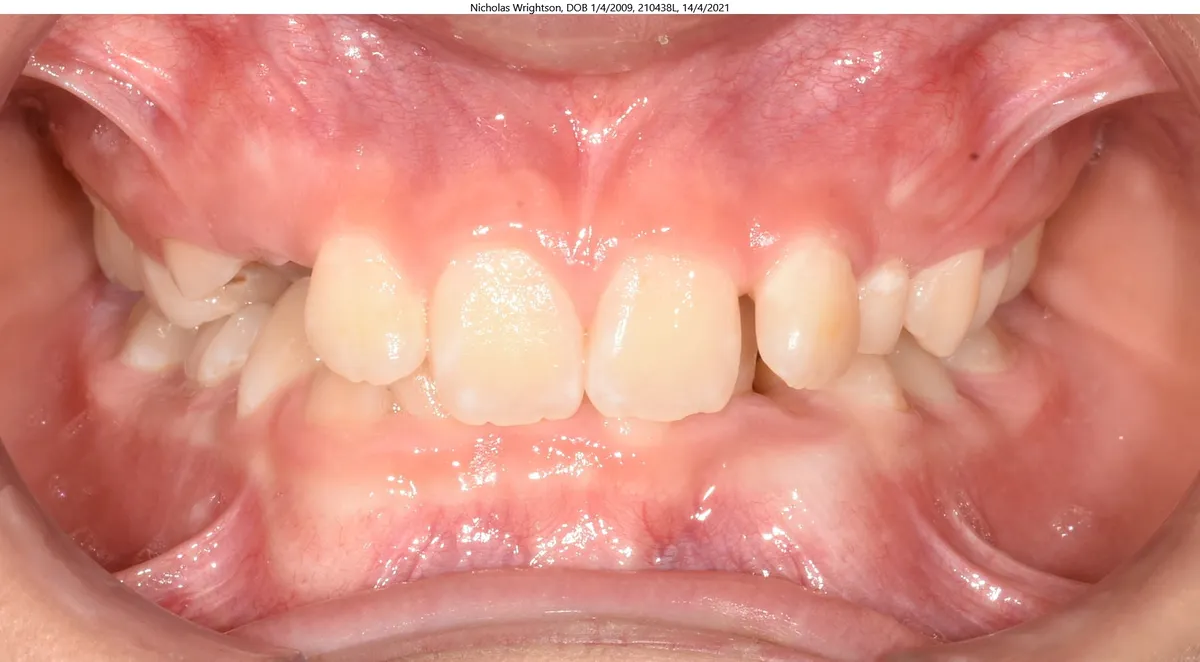 Nicholas's smile before Invisalign® treatment Nicholas's smile before Invisalign® treatment
