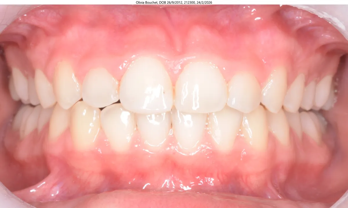 Olivia's smile after Expander & Invisalign® treatment Olivia's smile after Expander & Invisalign® treatment