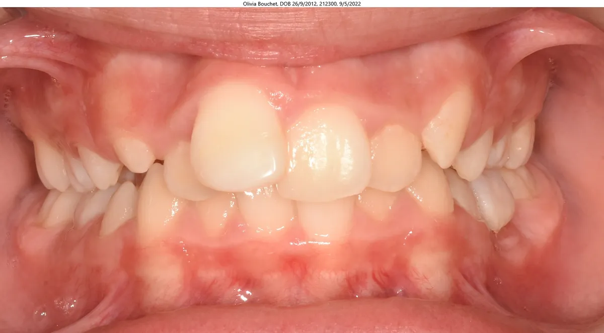 Olivia's smile before Expander & Invisalign® treatment Olivia's smile before Expander & Invisalign® treatment