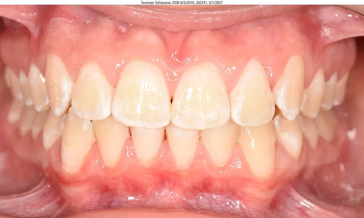 Summer's smile after Invisalign® treatment Summer's smile after Invisalign® treatment