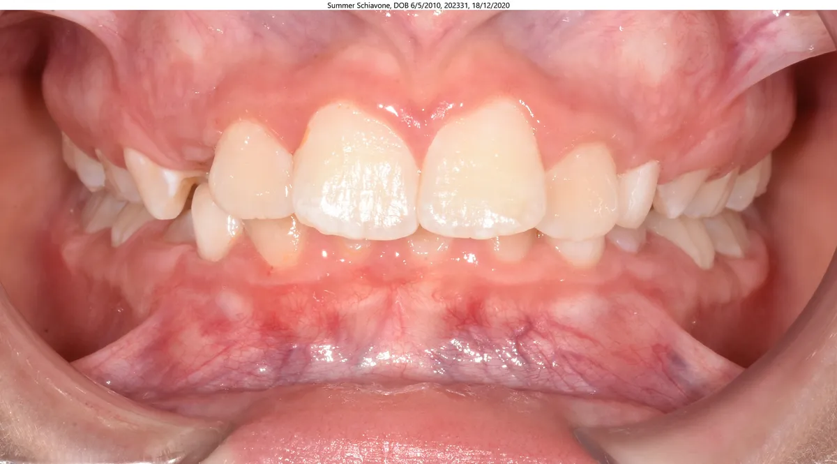 Summer's smile before Invisalign® treatment Summer's smile before Invisalign® treatment