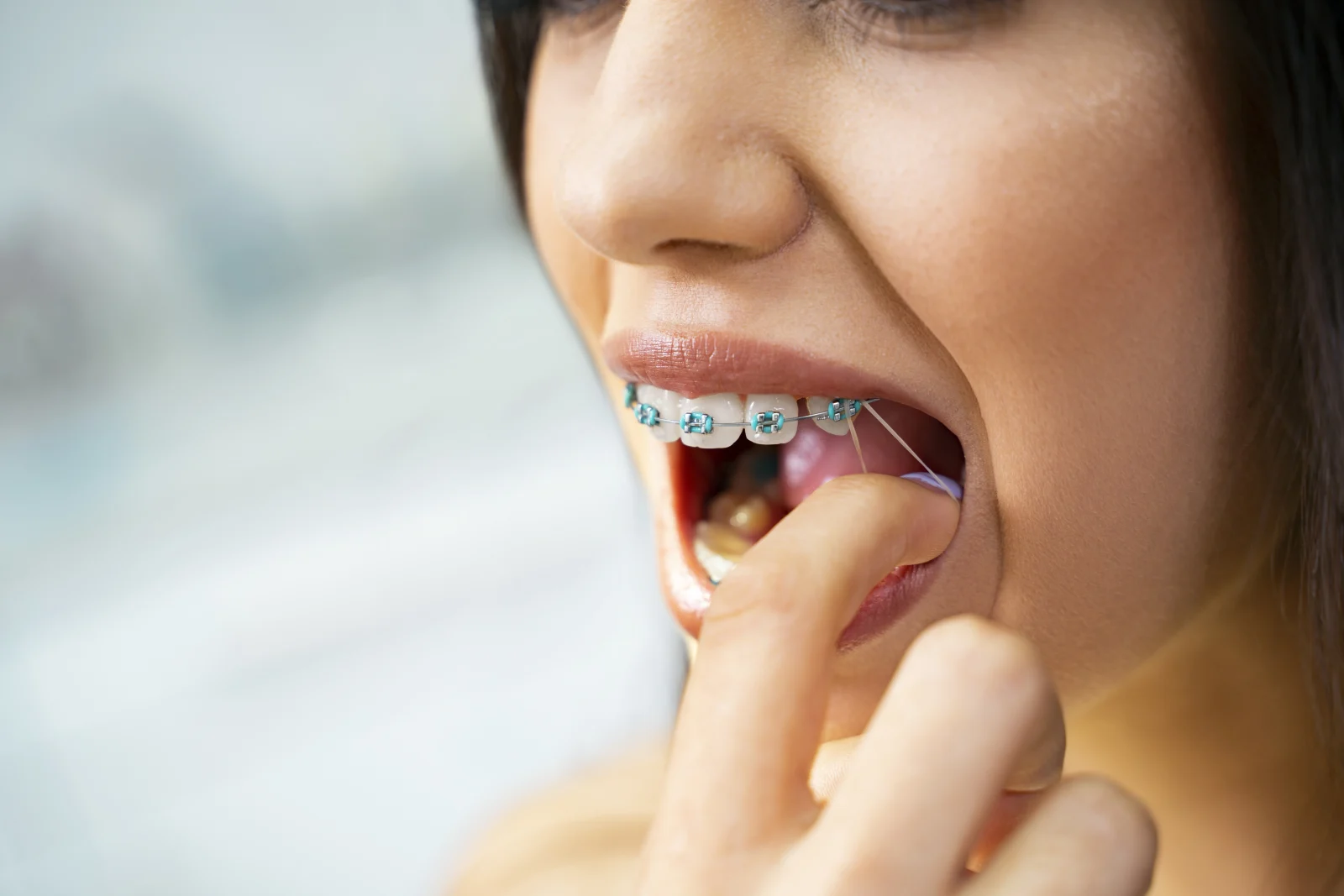 Orthodontic elastics on braces used to help correct an overbite Orthodontic elastics on braces used to help correct an overbite