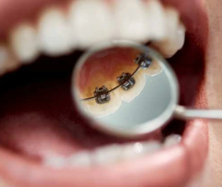 A teenager smiling with no visible braces A teenager smiling with no visible braces