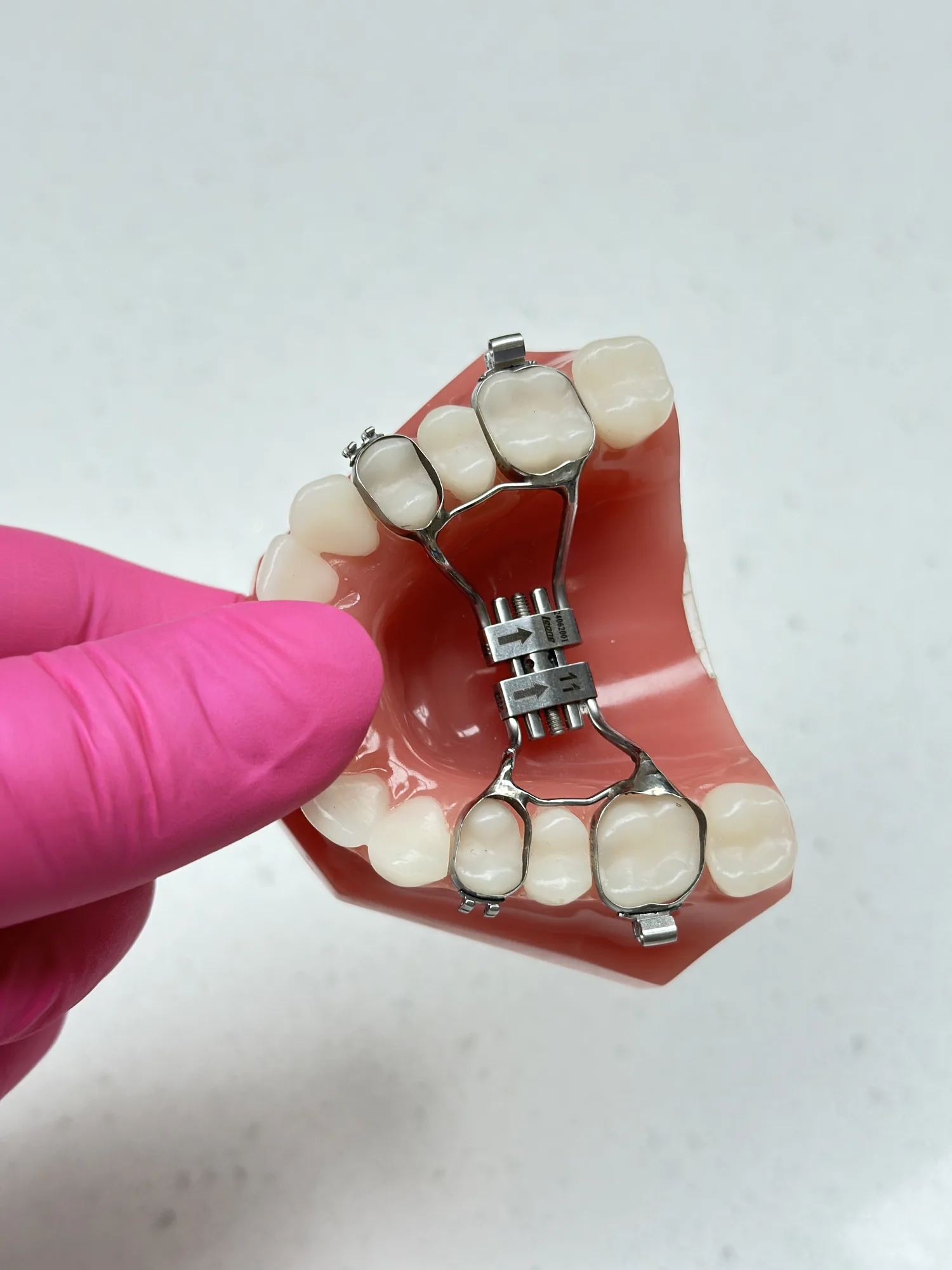 Diagram of a palatal expander widening the upper jaw