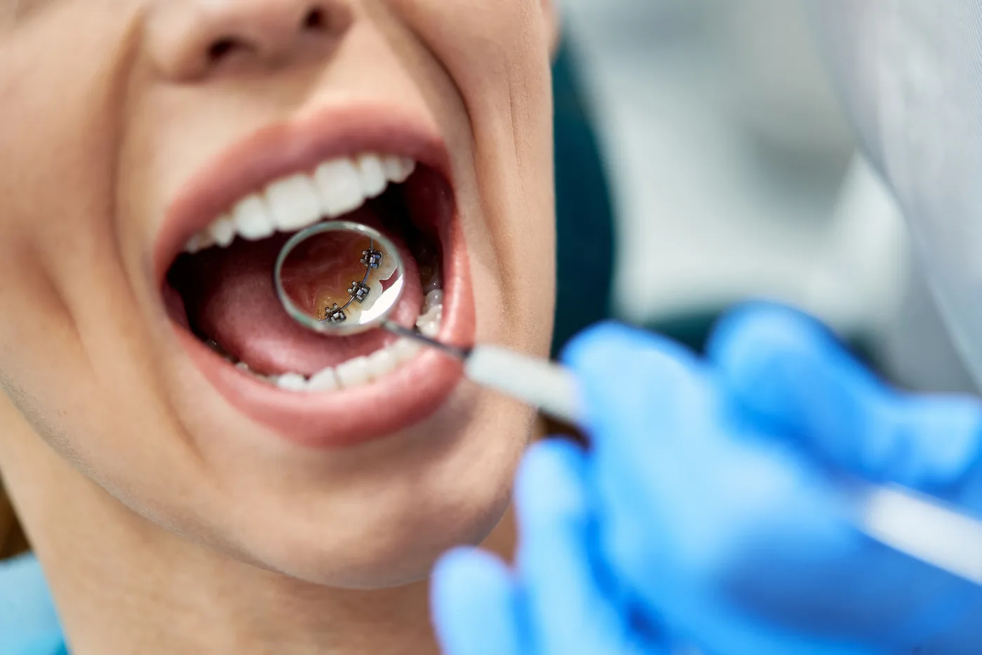 Close-up of lingual braces fitted to the inside of the teeth