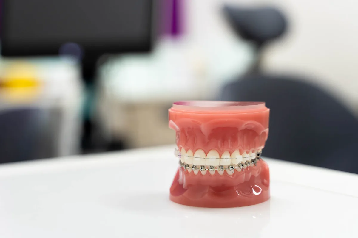 Braces for teenagers Braces for teenagers
