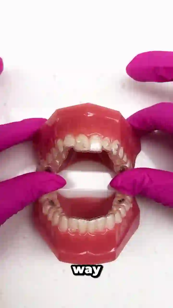 Demonstration of inserting and removing Invisalign aligners