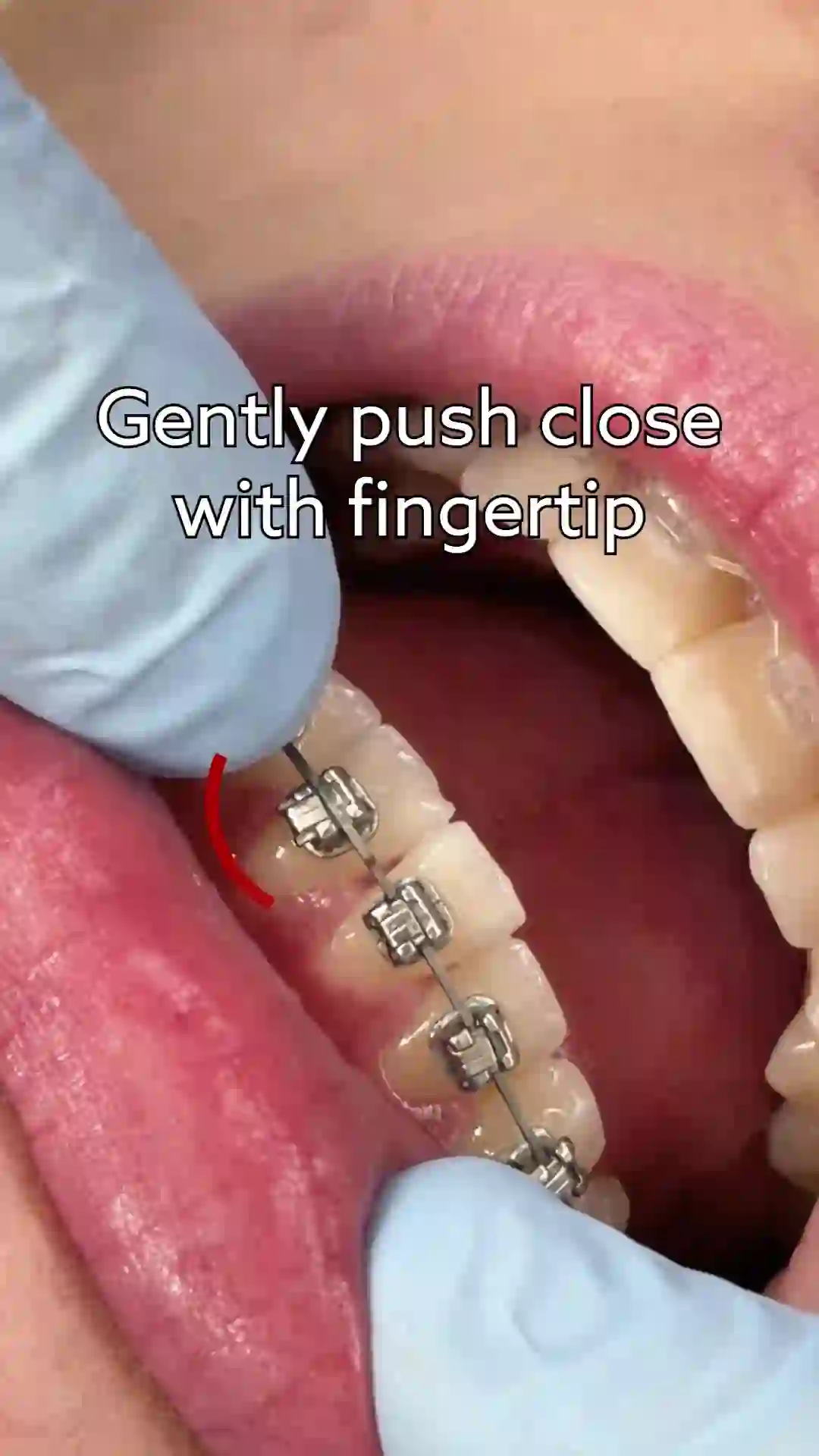 Demonstration of how to close a gate on self-ligating braces