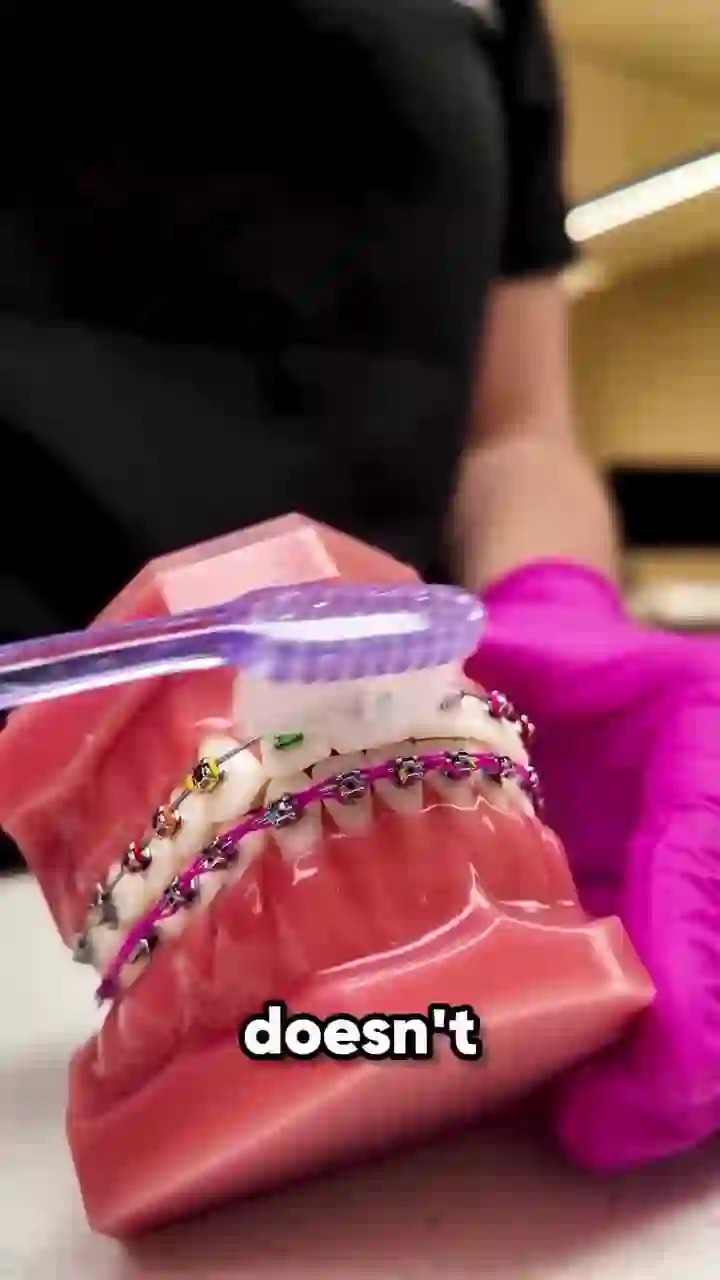 Demonstration of correct brushing technique with braces