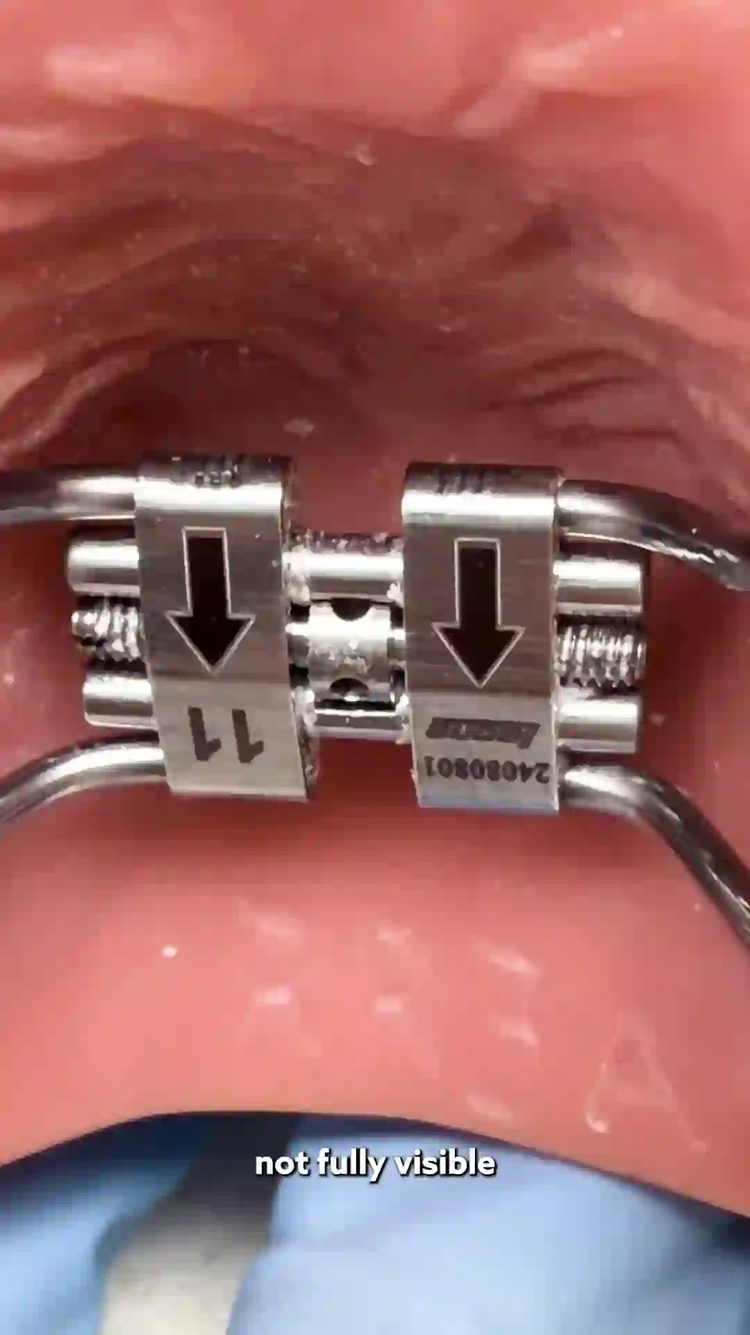 Demonstration of how to complete a rapid palate expander turn