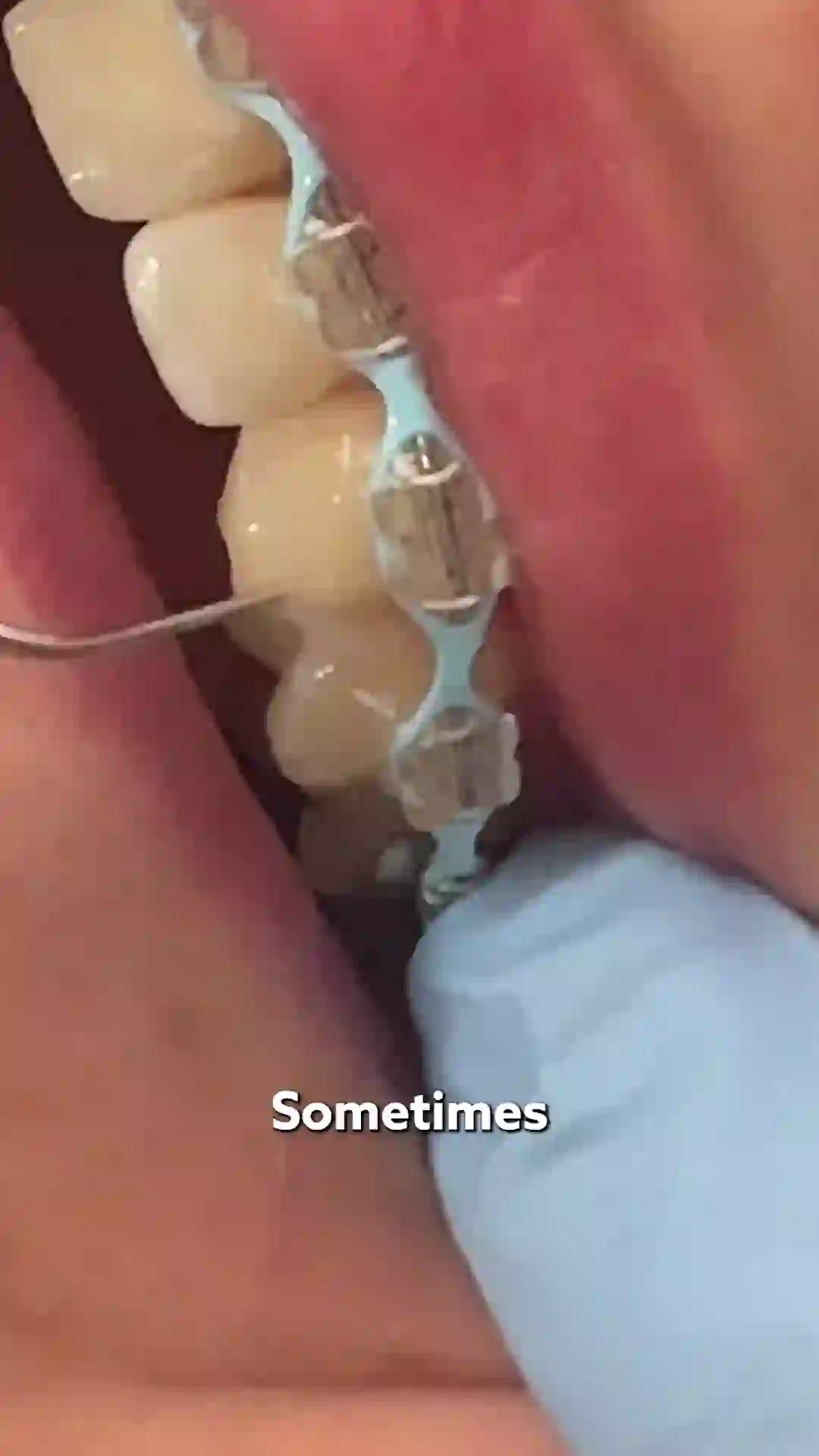 Demonstration of how to tuck a loose tie on braces